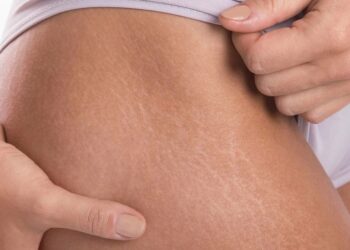 Best Stretch Mark Creams: Top Product Picks for Stretch Marks