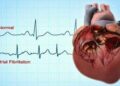 Atrial fibrillation and stress have bidirectional relationship, finds study